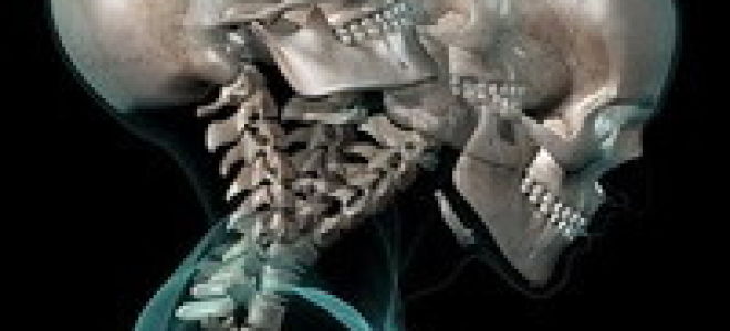 Хлыстовая травма шейного отдела позвоночника