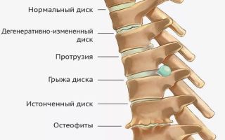 Остеохондроз межпозвонковых дисков — опасность для всего организма