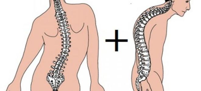 Кифоз ― знак вопроса в спине