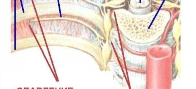 Как вылечить невралгию с помощью народных средств