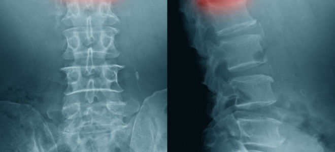 Лфк для пациентов с остеопорозом и остеопорозными переломами позвоночника