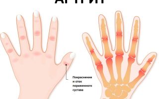 Методы лечения воспалительных заболеваний коленных суставов