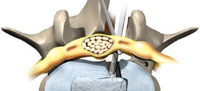 Миелорадикулопатия при стенозе позвоночника